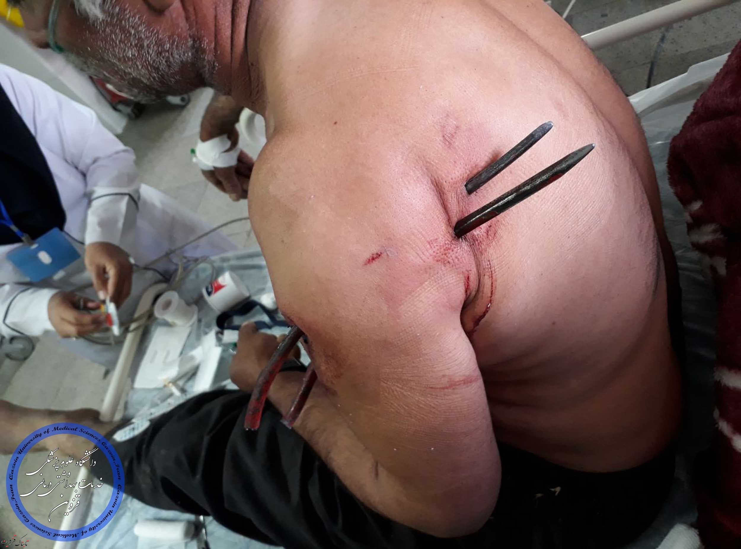 بیرون آوردن چنگک کشاورزی از بدن مرد 60 ساله در بیمارستان «شفا» تاکستان